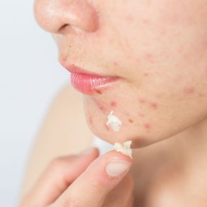 1 Portrait of young Asian woman having acne problem and she applying acne cream on her face