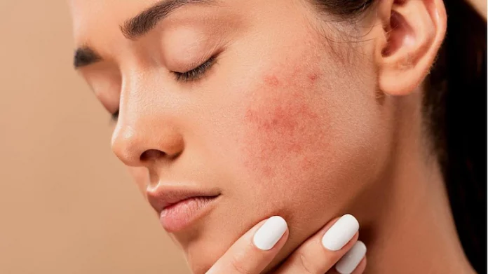 How to remove pimple marks naturally at home?
